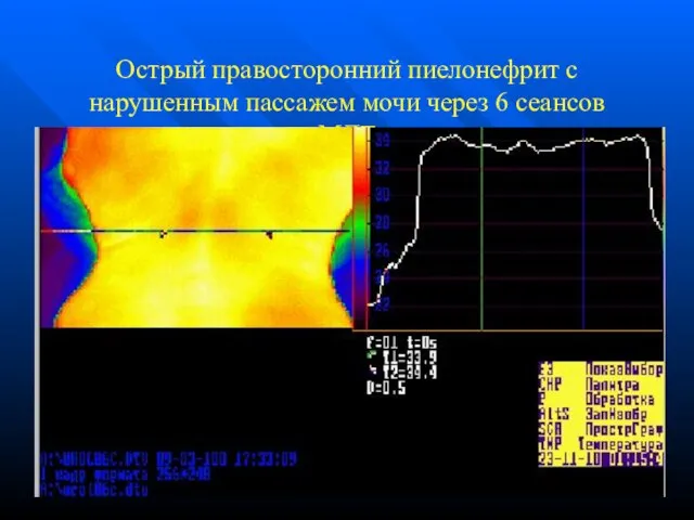 Острый правосторонний пиелонефрит с нарушенным пассажем мочи через 6 сеансов МЛТ