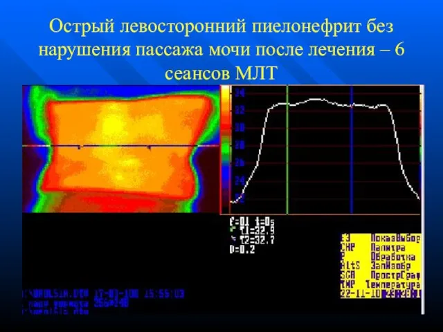 Острый левосторонний пиелонефрит без нарушения пассажа мочи после лечения – 6 сеансов МЛТ