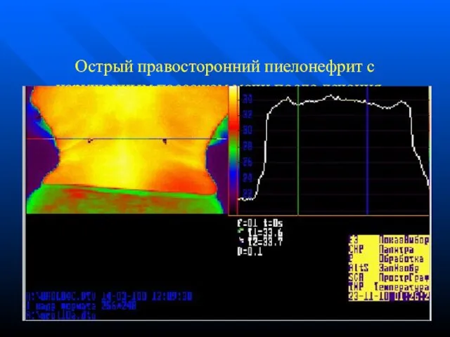 Острый правосторонний пиелонефрит с нарушенным пассажем мочи после лечения – 10 сеансов МЛТ