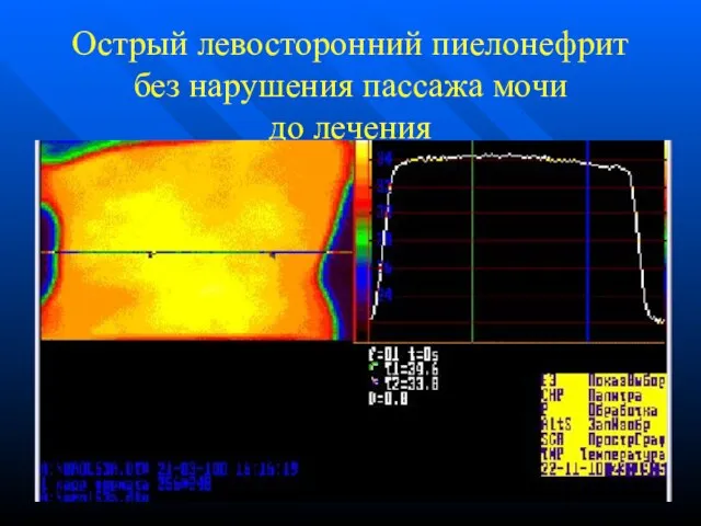 Острый левосторонний пиелонефрит без нарушения пассажа мочи до лечения