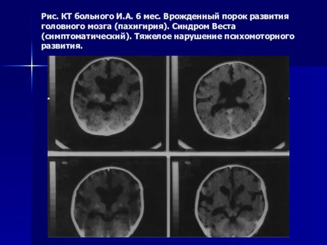 Рис. КТ больного И.А. 6 мес. Врожденный порок развития головного мозга (пахигирия).