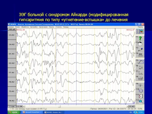 ЭЭГ больной с синдромом Айкарди (модифицированная гипсаритмия по типу «угнетение-вспышка» до лечения