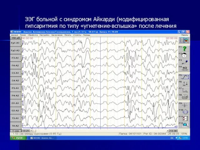 ЭЭГ больной с синдромом Айкарди (модифицированная гипсаритмия по типу «угнетение-вспышка» после лечения