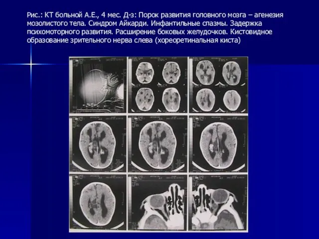 Рис.: КТ больной А.Е., 4 мес. Д-з: Порок развития головного мозга –