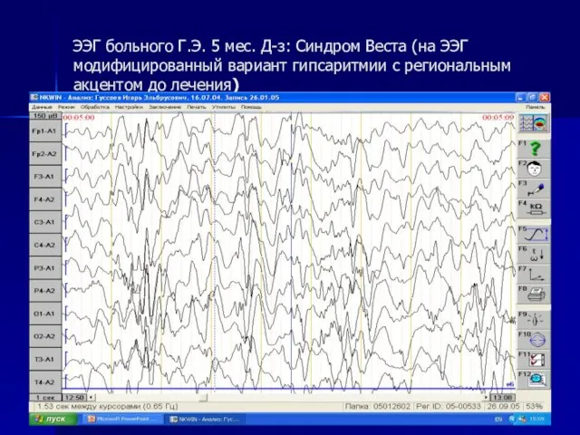 ЭЭГ больного Г.Э. 5 мес. Д-з: Синдром Веста (на ЭЭГ модифицированный вариант