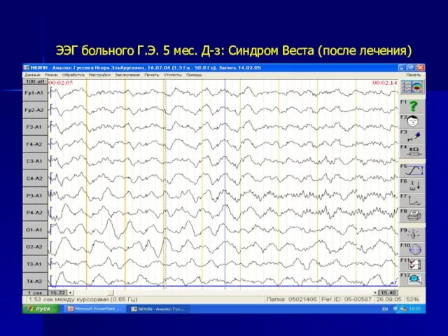 ЭЭГ больного Г.Э. 5 мес. Д-з: Синдром Веста (после лечения)