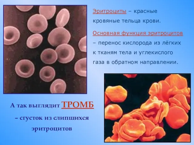 А так выглядит ТРОМБ – сгусток из слипшихся эритроцитов Эритроциты – красные