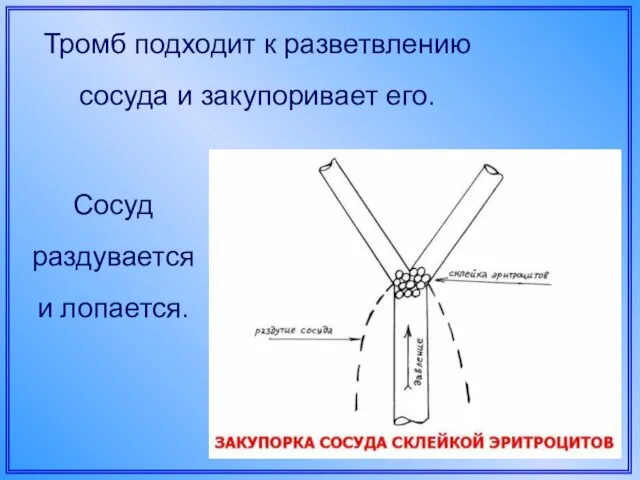 Тромб подходит к разветвлению сосуда и закупоривает его. Сосуд раздувается и лопается.