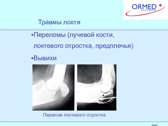 Травмы локтя Переломы (лучевой кости, локтевого отростка, предплечья) Вывихи Перелом локтевого отростка