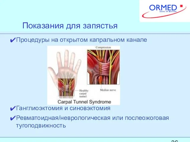 Показания для запястья Процедуры на открытом капральном канале Ганглиоэктомия и синовэктомия Ревматоидная/неврологическая или послеожоговая тугоподвижность