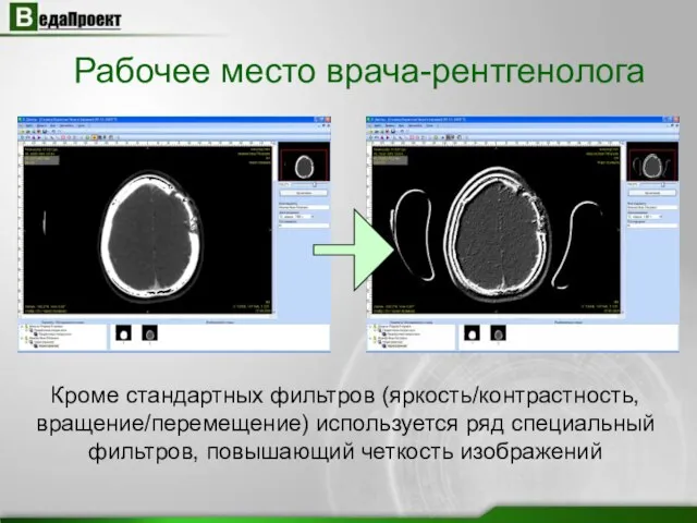 Рабочее место врача-рентгенолога Кроме стандартных фильтров (яркость/контрастность, вращение/перемещение) используется ряд специальный фильтров, повышающий четкость изображений