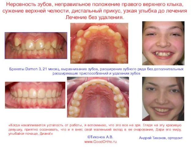 Неровность зубов, неправильное положение правого верхнего клыка, сужение верхней челюсти, дистальный прикус,