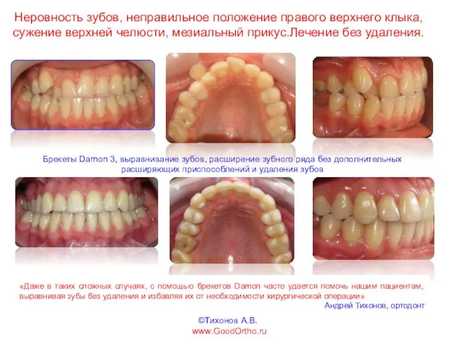 Неровность зубов, неправильное положение правого верхнего клыка, сужение верхней челюсти, мезиальный прикус.Лечение