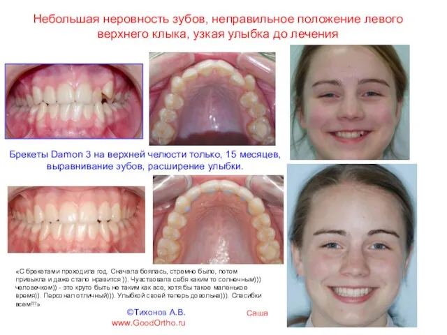 Небольшая неровность зубов, неправильное положение левого верхнего клыка, узкая улыбка до лечения