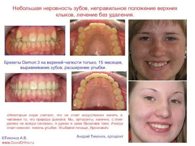 Небольшая неровность зубов, неправильное положение верхних клыков, лечение без удаления. Брекеты Damon
