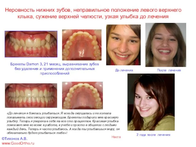 Неровность нижних зубов, неправильное положение левого верхнего клыка, сужение верхней челюсти, узкая