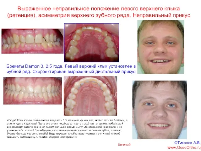 Выраженное неправильное положение левого верхнего клыка (ретенция), асимметрия верхнего зубного ряда. Неправильный