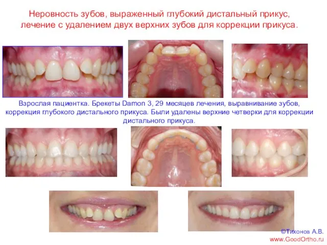 Неровность зубов, выраженный глубокий дистальный прикус, лечение с удалением двух верхних зубов