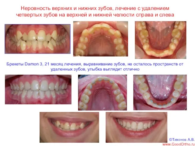 Неровность верхних и нижних зубов, лечение с удалением четвертых зубов на верхней