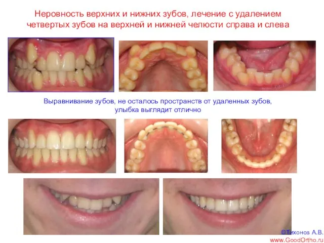 Неровность верхних и нижних зубов, лечение с удалением четвертых зубов на верхней