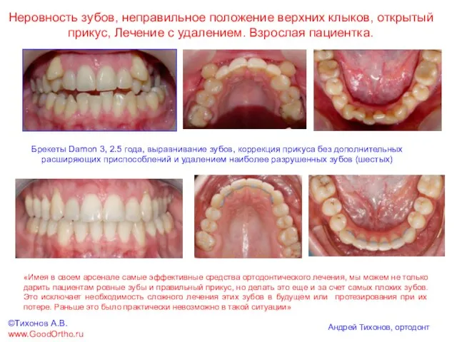 Неровность зубов, неправильное положение верхних клыков, открытый прикус, Лечение c удалением. Взрослая