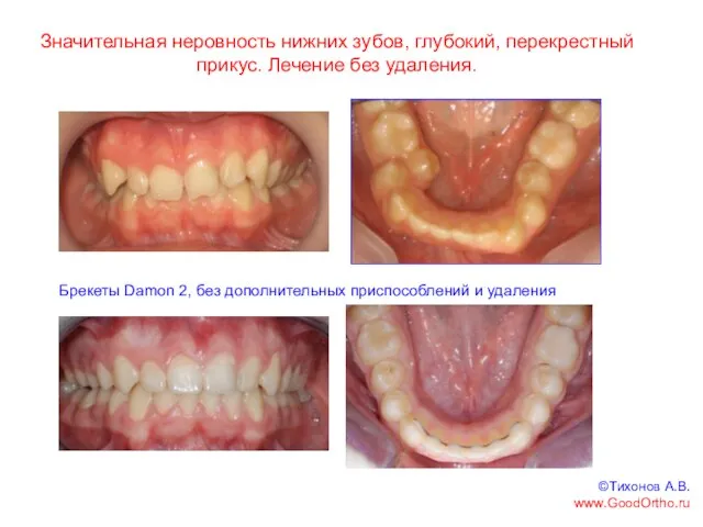 Значительная неровность нижних зубов, глубокий, перекрестный прикус. Лечение без удаления. Брекеты Damon