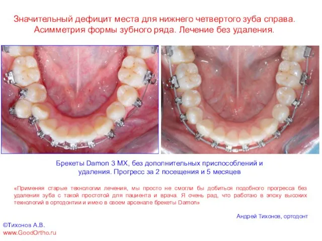 Значительный дефицит места для нижнего четвертого зуба справа. Асимметрия формы зубного ряда.