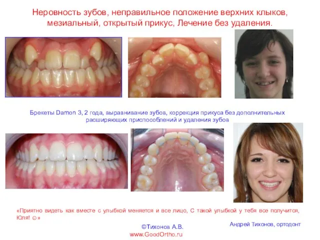 Неровность зубов, неправильное положение верхних клыков, мезиальный, открытый прикус, Лечение без удаления.