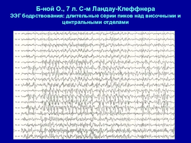 Б-ной О., 7 л. С-м Ландау-Клеффнера ЭЭГ бодрствования: длительные серии пиков над височными и центральными отделами