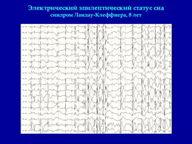 Электрический эпилептический статус сна синдром Ландау-Клеффнера, 8 лет