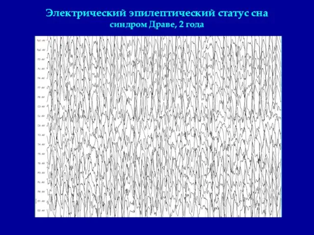 Электрический эпилептический статус сна синдром Драве, 2 года