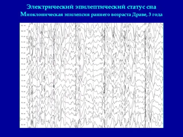 Электрический эпилептический статус сна Миоклоническая эпилепсия раннего возраста Драве, 3 года