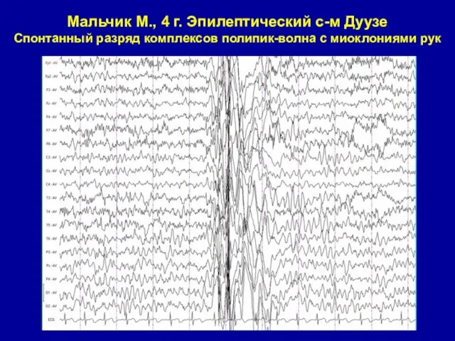 Мальчик М., 4 г. Эпилептический с-м Дуузе Спонтанный разряд комплексов полипик-волна с миоклониями рук