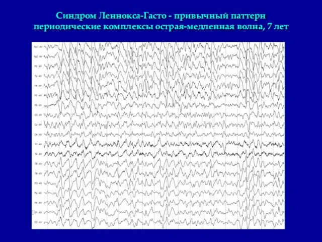 Синдром Леннокса-Гасто - привычный паттерн периодические комплексы острая-медленная волна, 7 лет