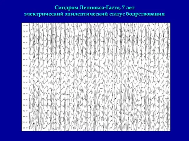 Синдром Леннокса-Гасто, 7 лет электрический эпилептический статус бодрствования