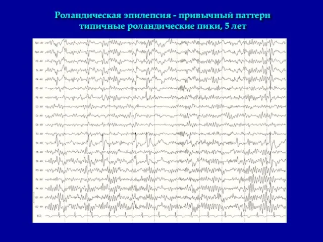 Роландическая эпилепсия - привычный паттерн типичные роландические пики, 5 лет