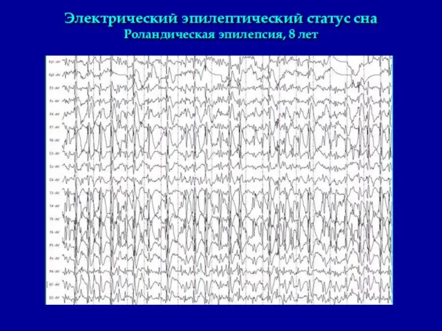 Электрический эпилептический статус сна Роландическая эпилепсия, 8 лет