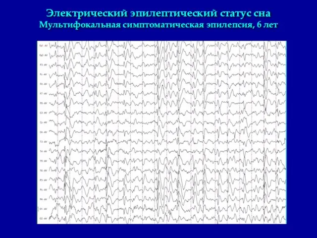 Электрический эпилептический статус сна Мультифокальная симптоматическая эпилепсия, 6 лет