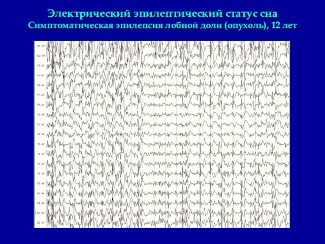 Электрический эпилептический статус сна Симптоматическая эпилепсия лобной доли (опухоль), 12 лет