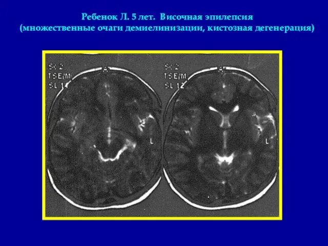 Ребенок Л. 5 лет. Височная эпилепсия (множественные очаги демиелинизации, кистозная дегенерация)