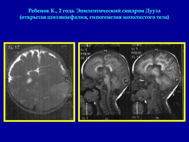 Ребенок К., 2 года. Эпилептический синдром Дууза (открытая шизэнцефалия, гипогенезия мозолистого тела)