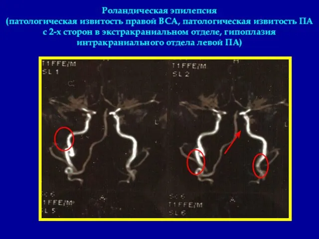 Роландическая эпилепсия (патологическая извитость правой ВСА, патологическая извитость ПА с 2-х сторон