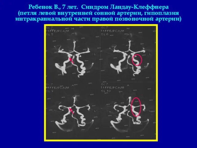 Ребенок В., 7 лет. Синдром Ландау-Клеффнера (петля левой внутренней сонной артерии, гипоплазия