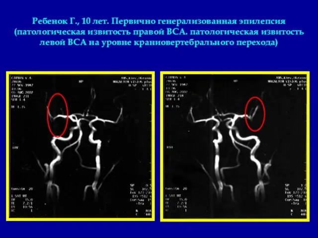 Ребенок Г., 10 лет. Первично генерализованная эпилепсия (патологическая извитость правой ВСА. патологическая