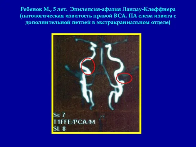 Ребенок М., 5 лет. Эпилепсия-афазия Ландау-Клеффнера (патологическая извитость правой ВСА. ПА слева