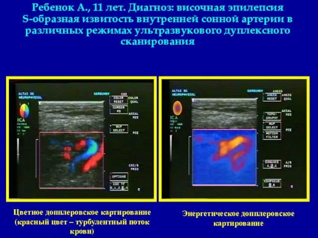 Ребенок А., 11 лет. Диагноз: височная эпилепсия S-образная извитость внутренней сонной артерии