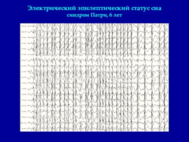 Электрический эпилептический статус сна синдром Патри, 6 лет