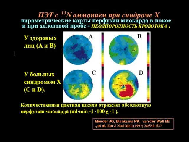 Количественная цветная шкала отражает абсолютную перфузию миокарда (ml·min -1 ·100 g -1