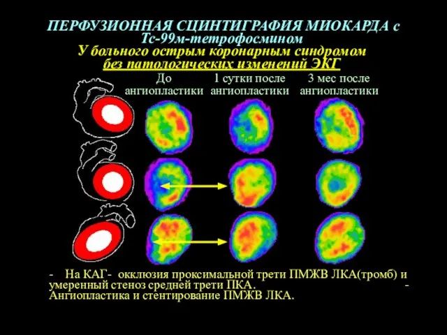 ПЕРФУЗИОННАЯ СЦИНТИГРАФИЯ МИОКАРДА с Тс-99м-тетрофосмином У больного острым коронарным синдромом без патологических