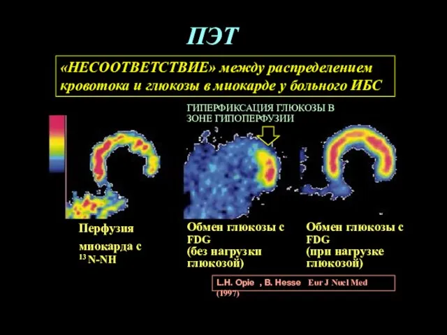 «НЕСООТВЕТСТВИЕ» между распределением кровотока и глюкозы в миокарде у больного ИБС L.H.